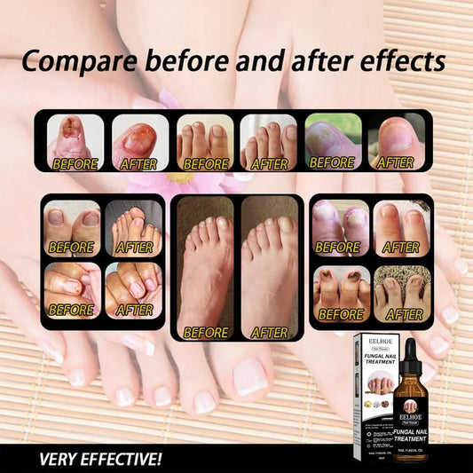 EELHOE - Nail Repair Fungal Oil
